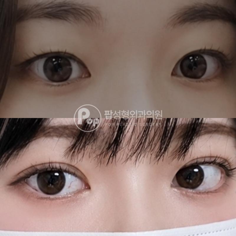 팝성형외과 속쌍→인아웃 자연유착 쌍수 후기