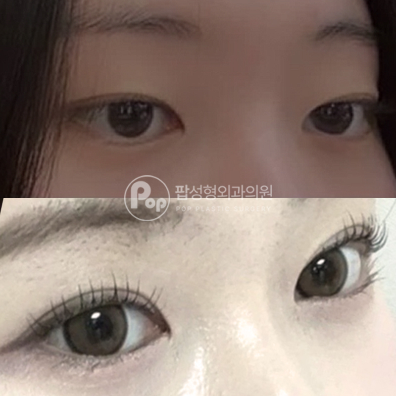 팝성형외과 인아웃 자연유착 후기