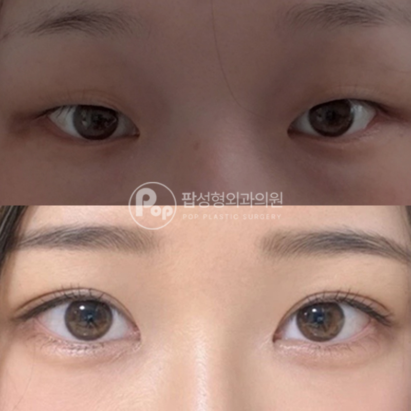 팝성형외과 무쌍 인아웃 자연유착 눈매교정 후기
