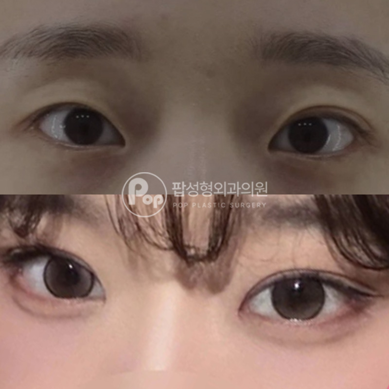 팝성형외과 첫 쌍수 인아웃라인
