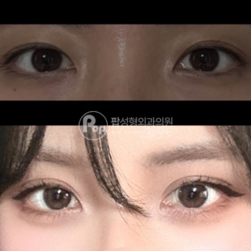 팝성형외과 세미아웃 자연유착 후기