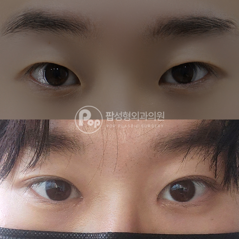 팝성형외과 남자 쌍수 후기