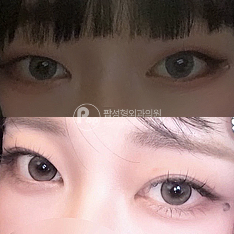 팝성형외과 무쌍 인아웃 자연유착 후기