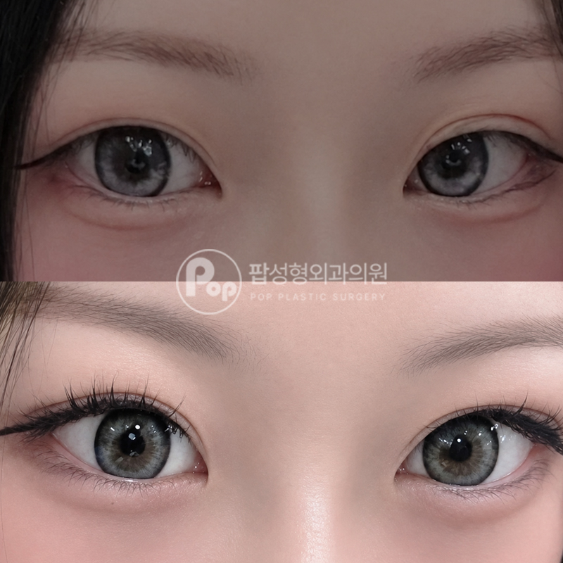 팝성형외과 풀린 라인, 졸린눈 눈재수술 후기