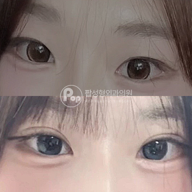 팝성형외과 작은 눈 자연유착 후기