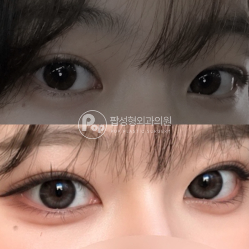 팝성형외과 매몰 몽고트임 뒤밑트임 후기
