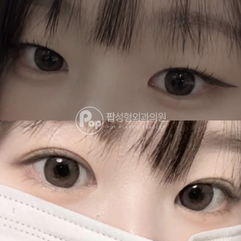 팝성형외과 비대칭 작은눈 개선