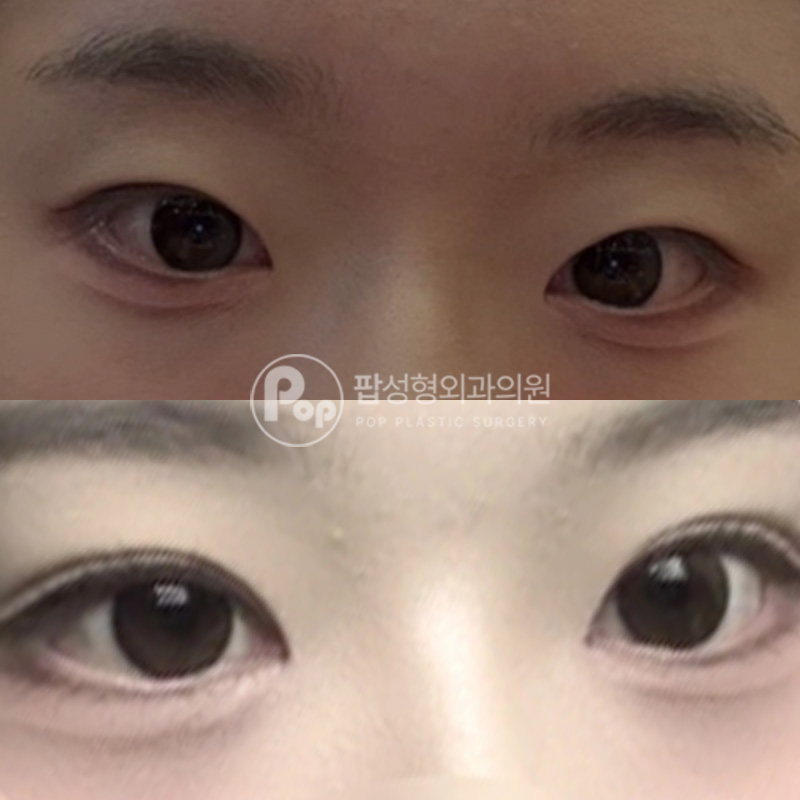 압구정 팝성형외과 풀린눈 자연유착 눈재수술