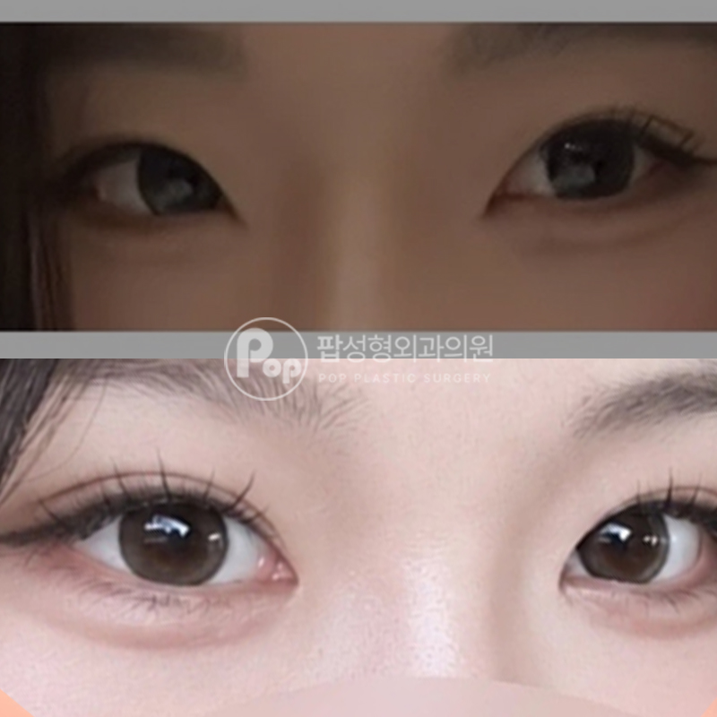 팝성형외과 졸린눈 자연유착 트임 쌍수 후기