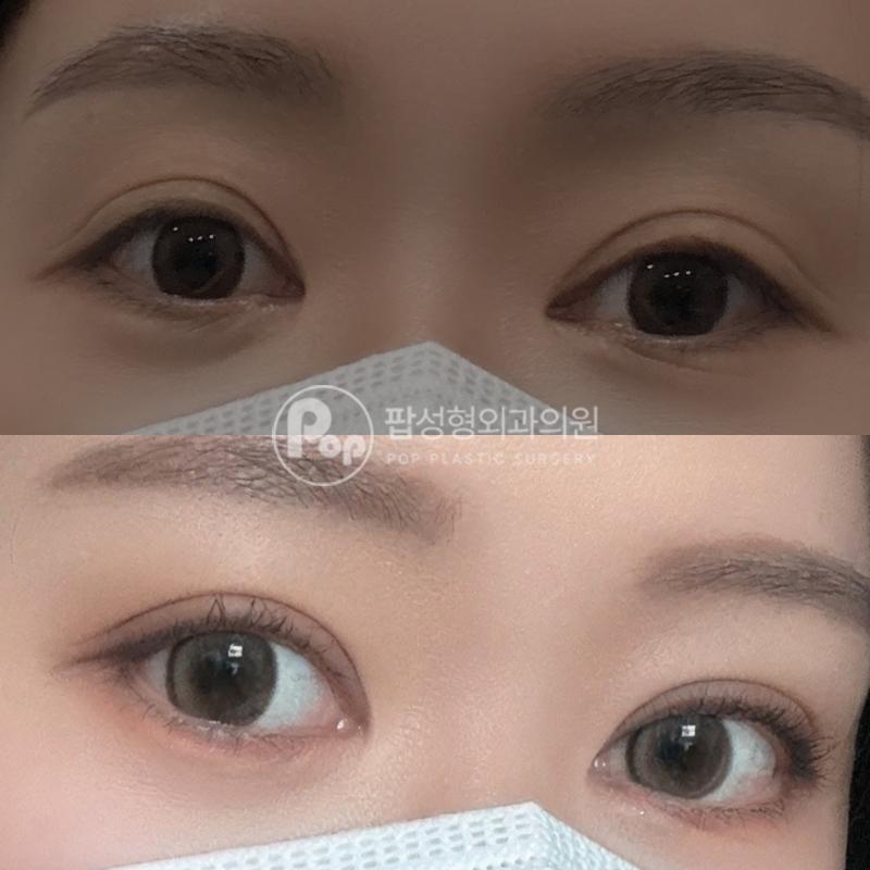 팝성형외과 겹쌍꺼풀 눈재수술 후기