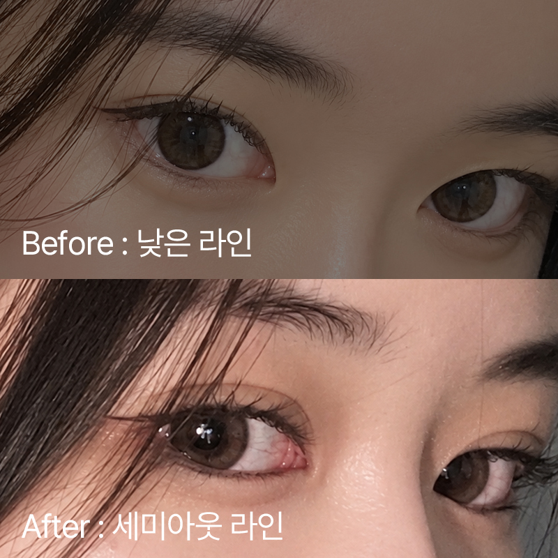 팝성형외과 낮은 라인 높이기 세미아웃라인 후기