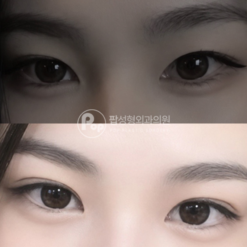 팝성형외과 인아웃라인 눈재수술 1개월차 후기