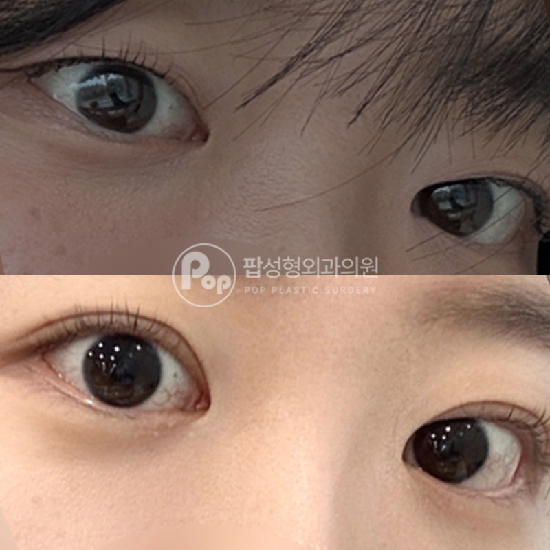 팝성형외과 지인추천 자연유착 후기