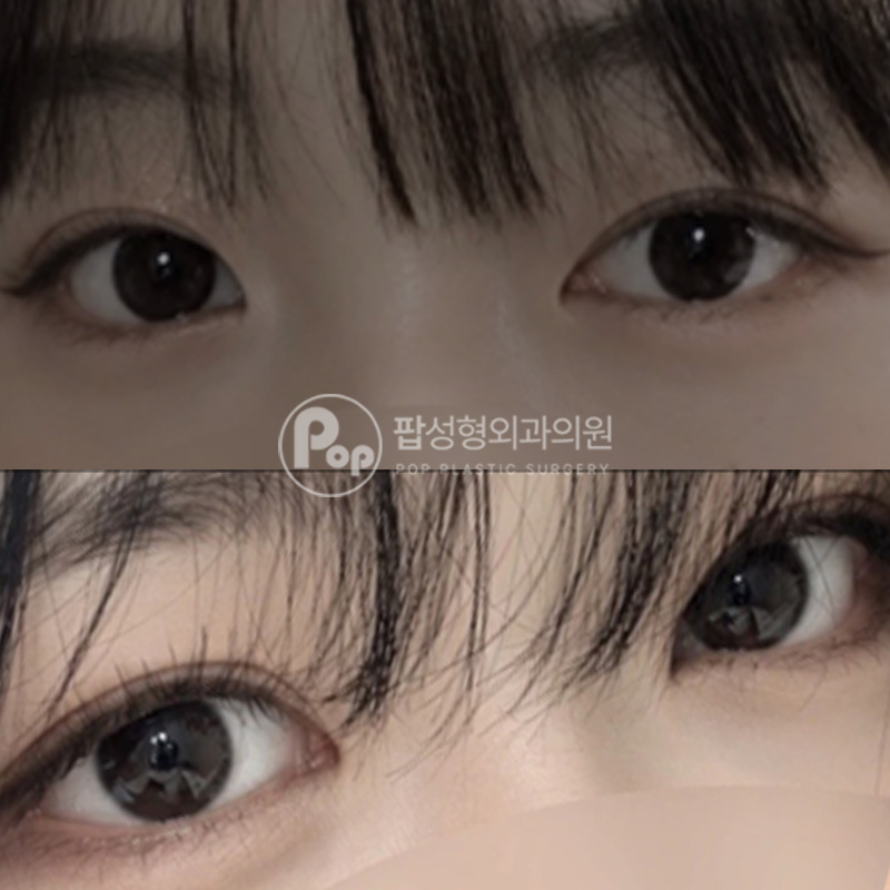 팝성형외과 라인높히기 자연유착 눈매교정 윗트임 뒤트임 눈재수술