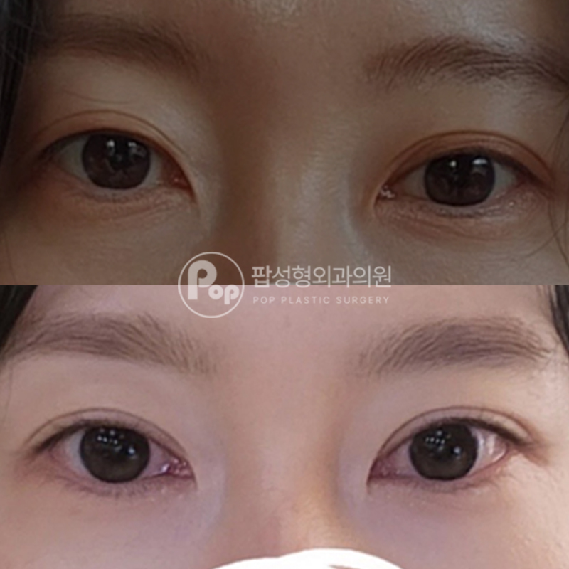 팝성형외과 처진눈 개선 쌍커풀 수술 후기