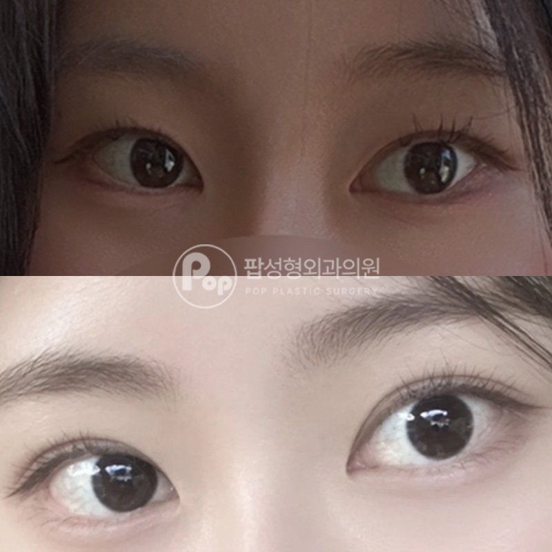 팝성형외과 눈매교정 자연유착 뒤트임 밑트임