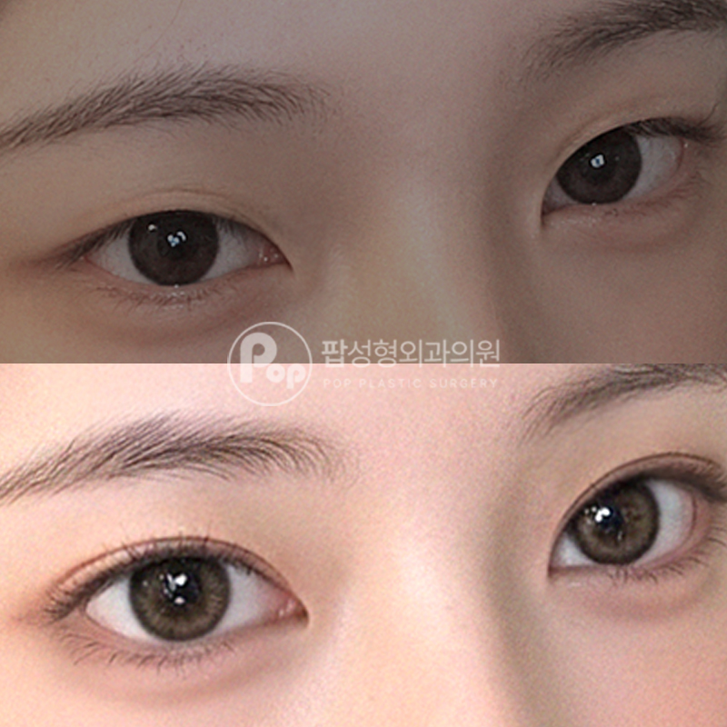 팝성형외과 무쌍 세미아웃 자연유착 후기