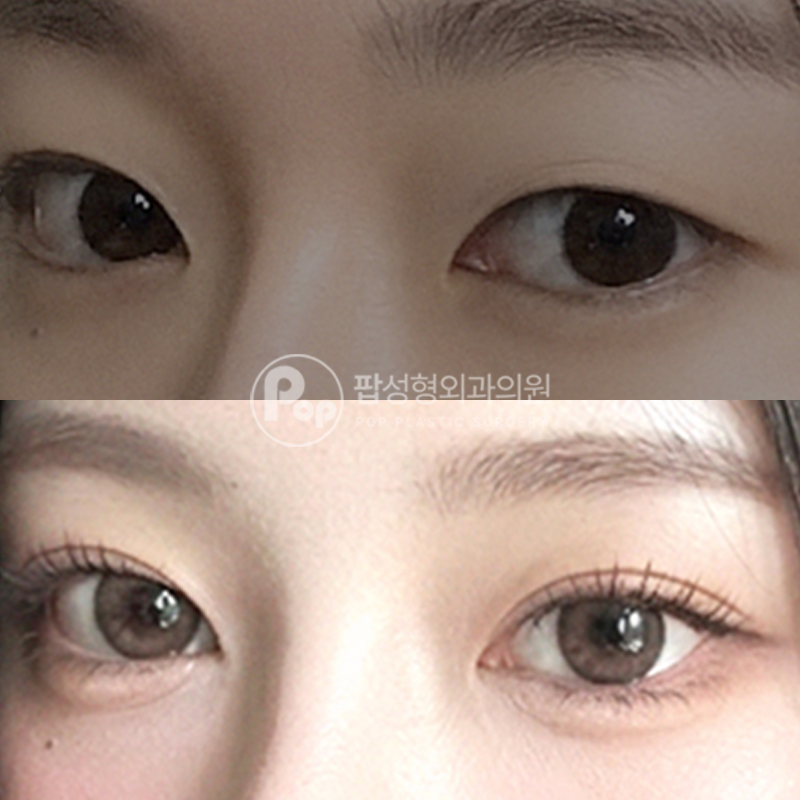 팝성형외과 인아웃라인 쌍수 눈성형 후기
