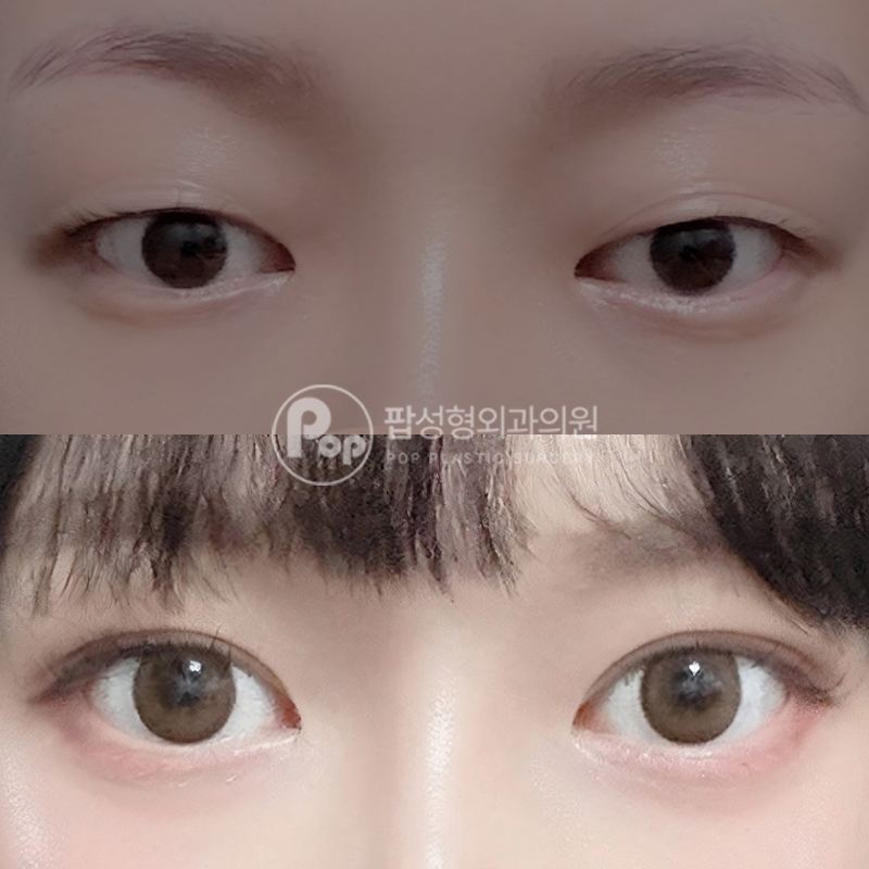 팝성형외과 겹쌍꺼풀 자연유착 후기