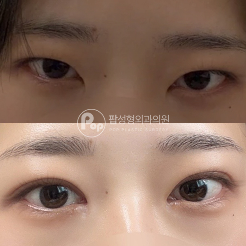 팝성형외과 처진 라인 눈재수술 후기