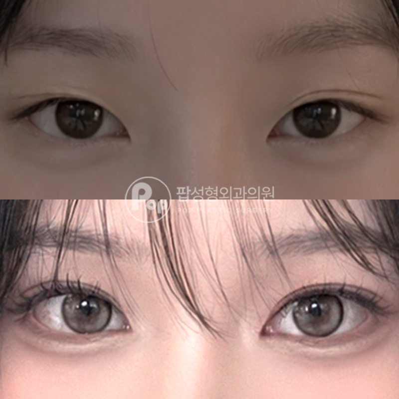 팝성형외과 짝눈 겹쌍 쌍수 눈재수술 후기