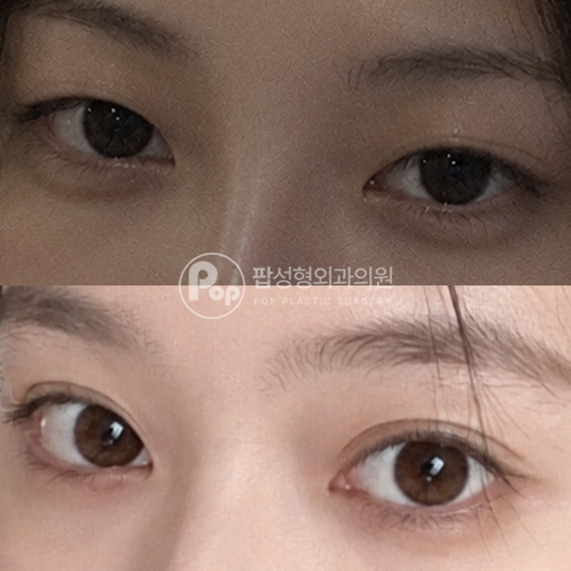 팝성형외과 쌍수 2주차 세미아웃라인 후기