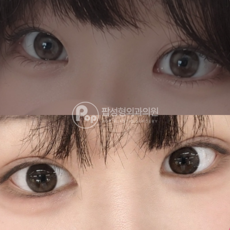 팝성형외과 사나운눈 무쌍 눈성형