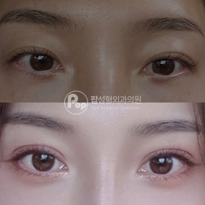 팝성형외과 세미아웃 눈재수술 후기