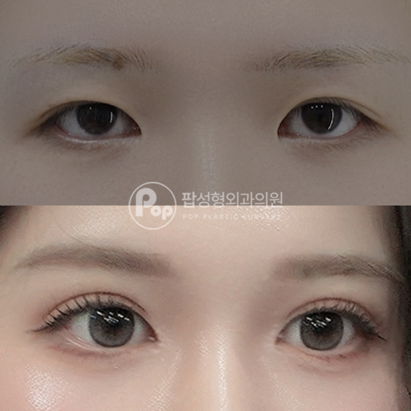 팝성형외과 풀린 쌍꺼풀 자연유착 후기