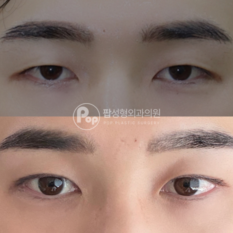 팝성형외과 남자눈성형 눈매교정 쌍수 후기