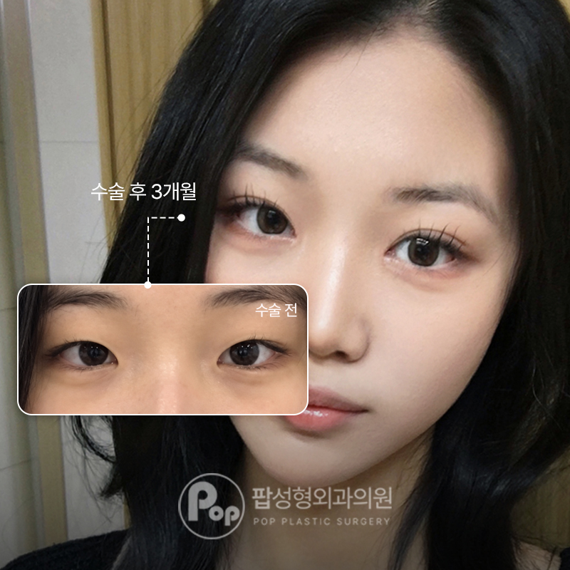 팝성형외과 무쌍에서 세미아웃라인 쌍수 후기