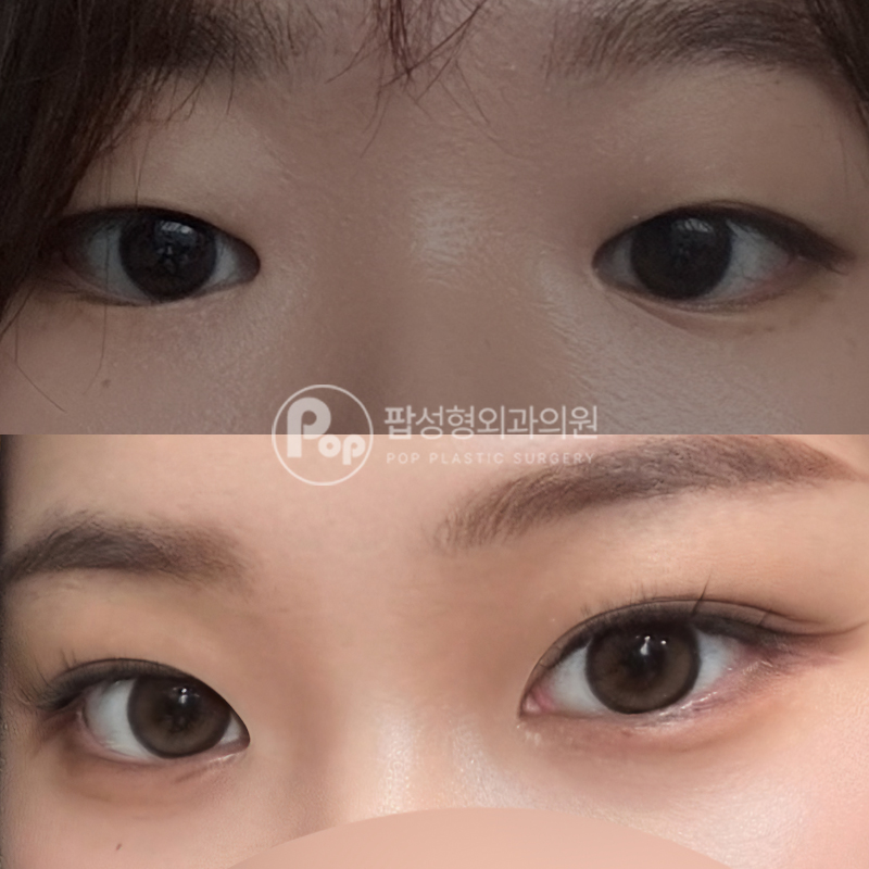 팝성형외과 작은눈 매몰 자연유착 후기