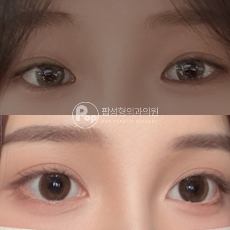 팝성형외과 세미아웃라인 눈재수술 2개월차 후기