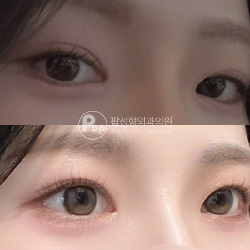 팝성형외과 뒤밑트임 눈성형 후기