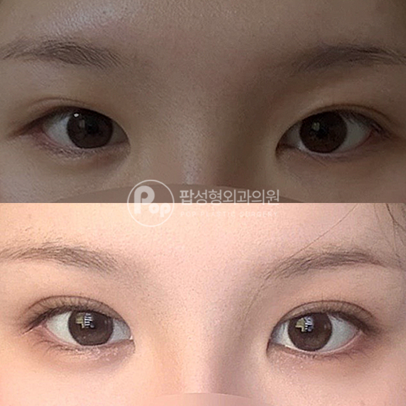 팝성형외과 풀린 라인 자연유착 후기
