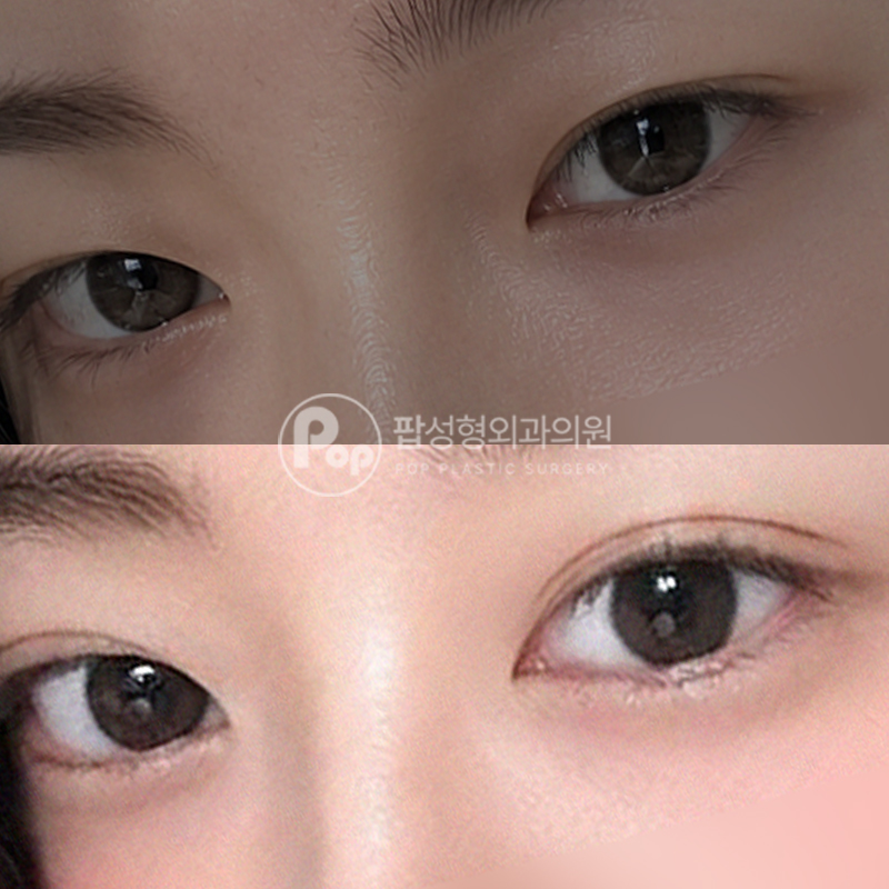 팝성형외과 세미아웃 자연유착 후기