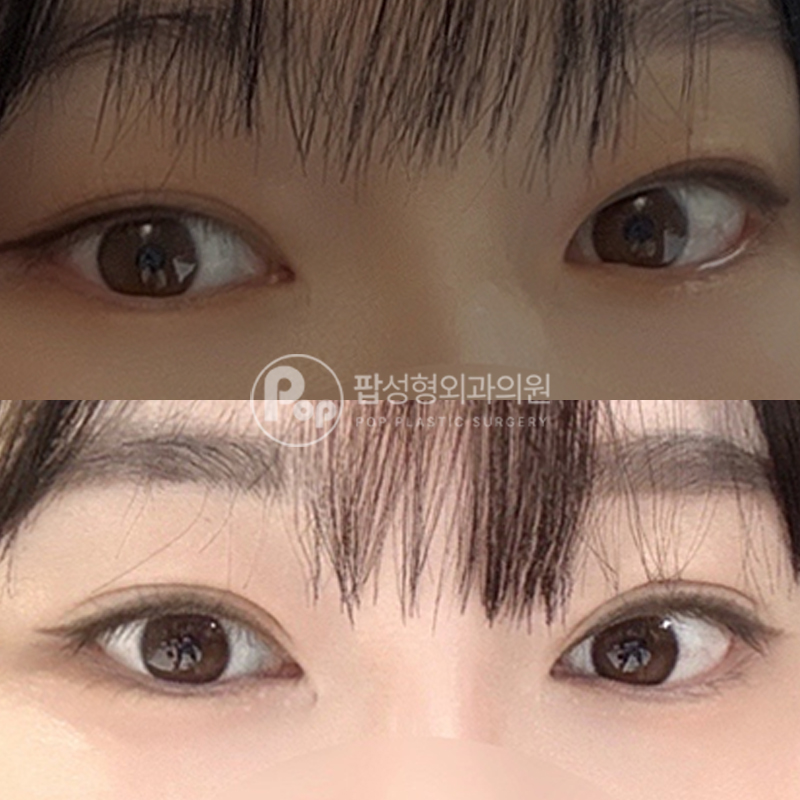팝성형외과 세미아웃 눈재수술 후기