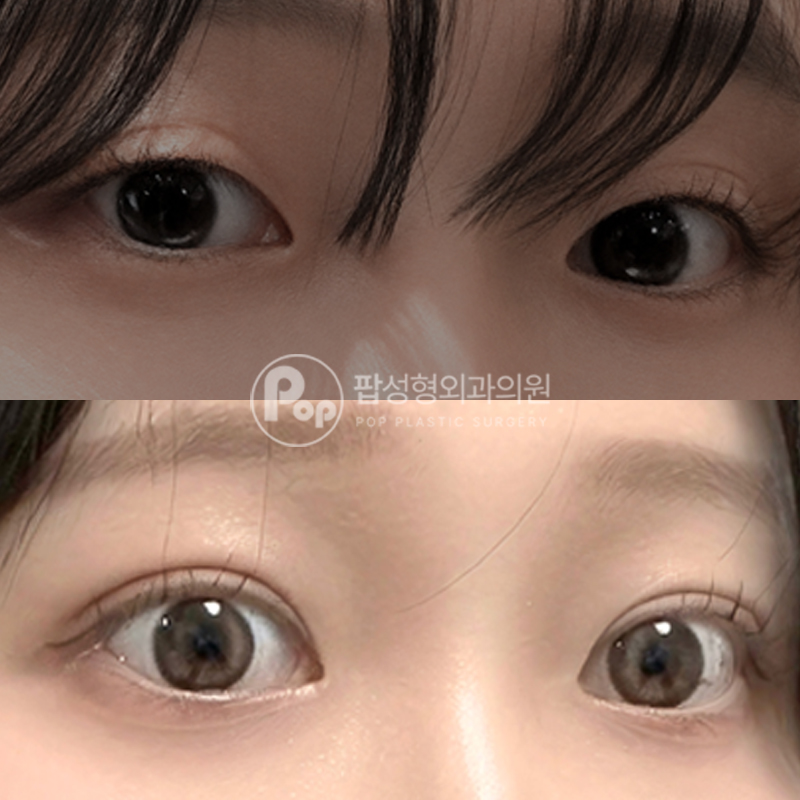 팝성형외과 비대칭라인 쌍수 후기