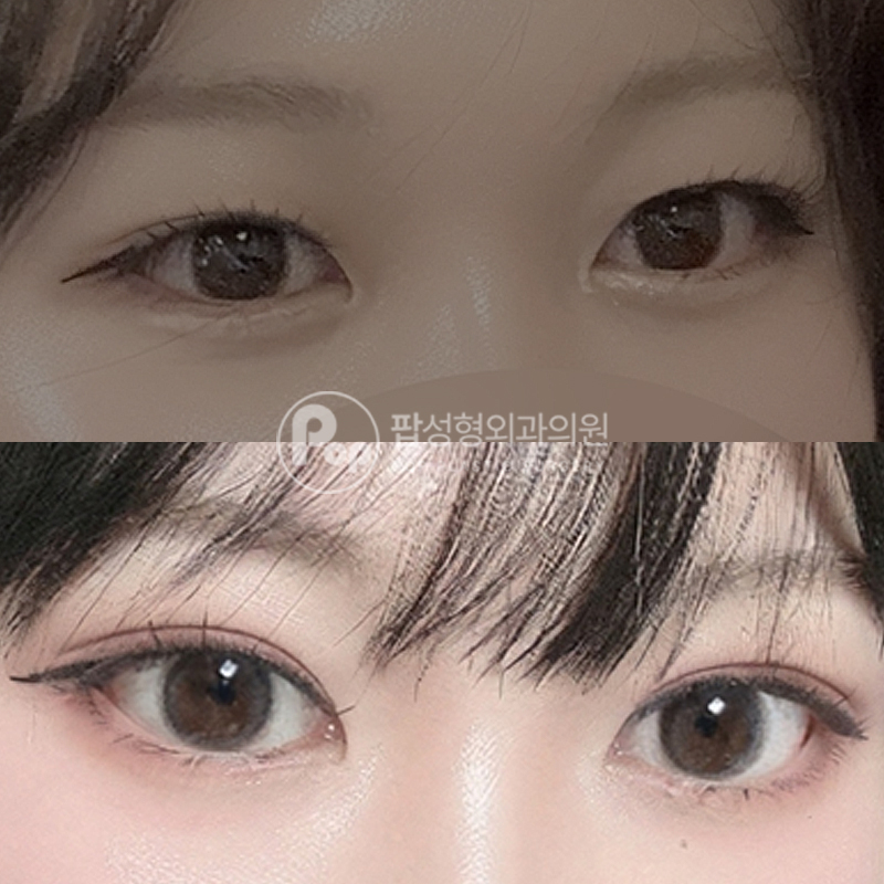 팝성형외과 짝눈에서 인아웃라인 자연유착 후기