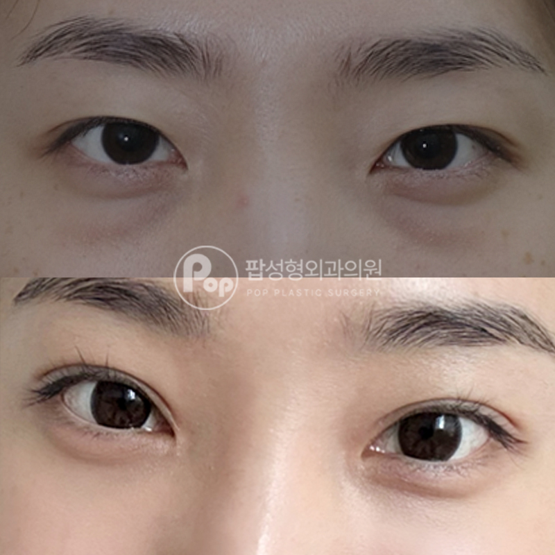 팝성형외과 눈밑지방재배치, 쌍수 후기