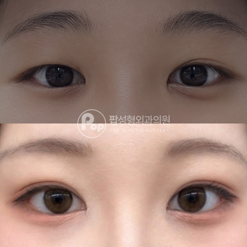 팝성형외과 풀린눈 눈재수술 2개월 후기