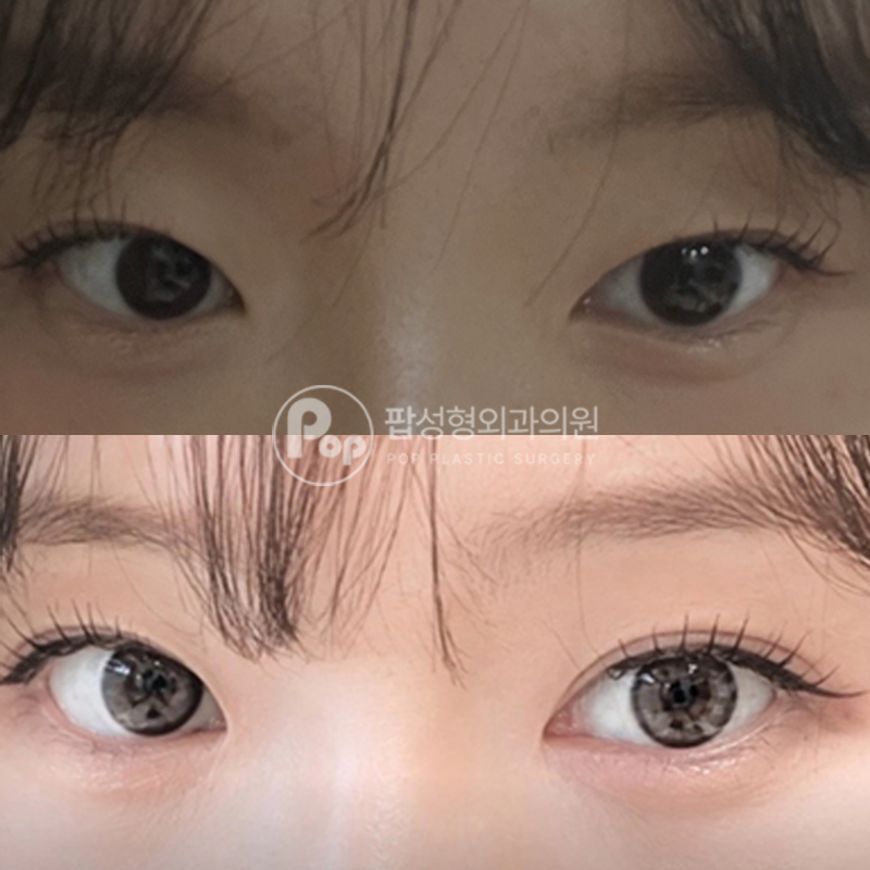팝성형외과 속쌍 비대칭라인 자연유착 후기