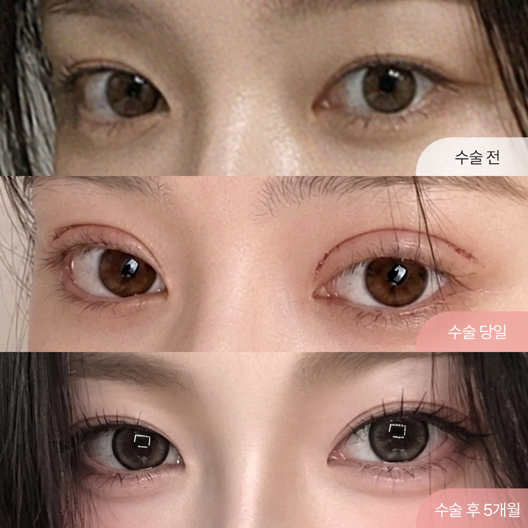 팝성형외과 세미아웃 자연유착 경과별 회복 후기