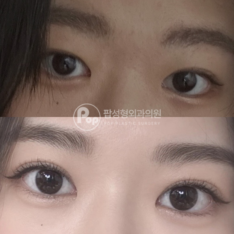 팝성형외과 인아웃라인으로 재수술