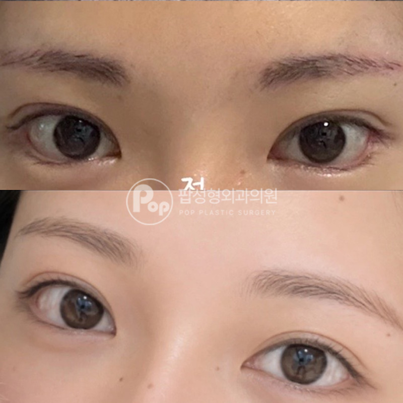 팝성형외과 작은눈 앞트임 윗트임 3개월차