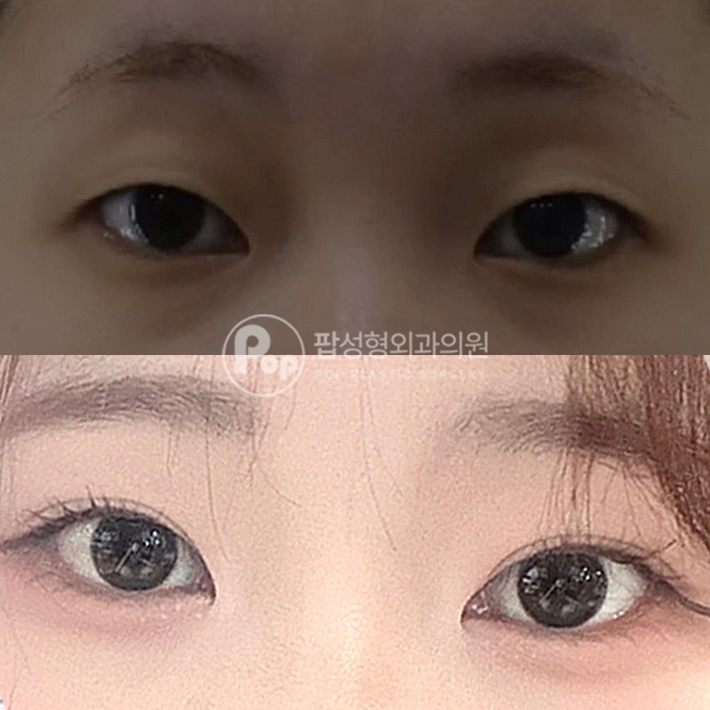 팝성형외과 작은 눈 자연유착 후기