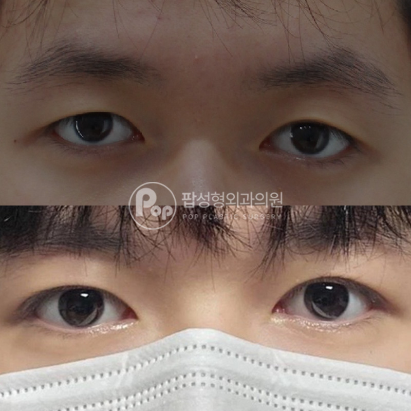 팝성형외과 남자눈 비대칭 개선