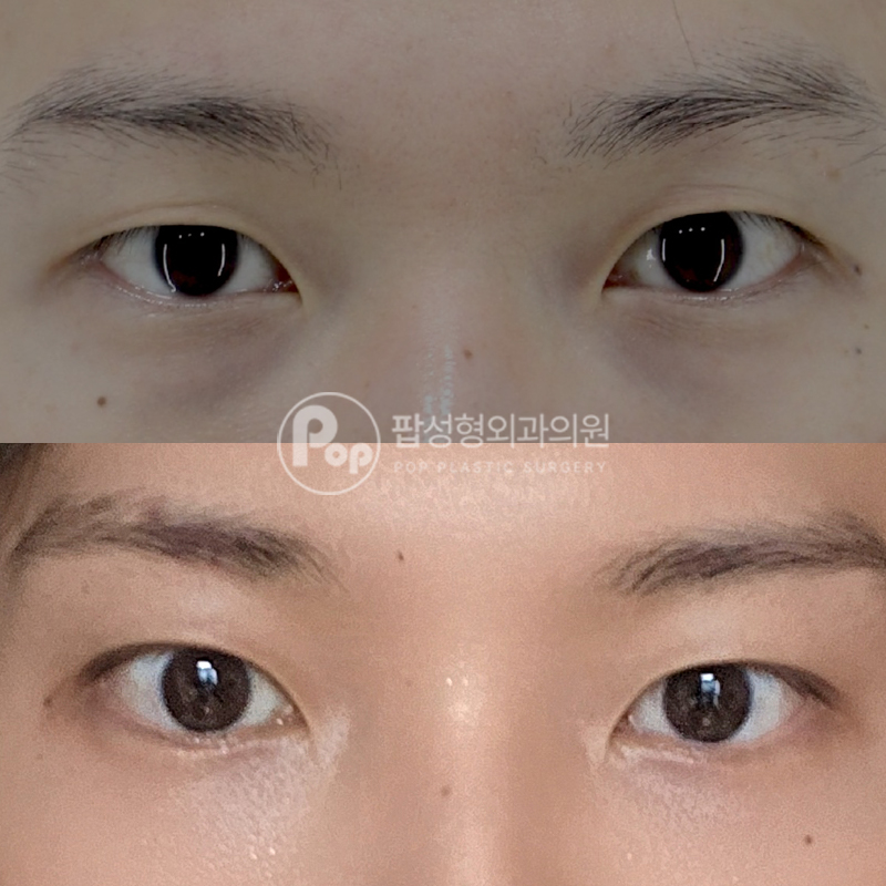 팝성형외과 남자눈성형 후기