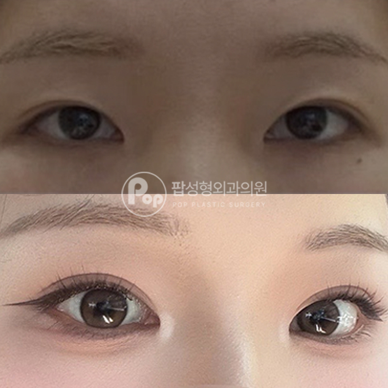팝성형외과 졸린 눈 자연유착 후기