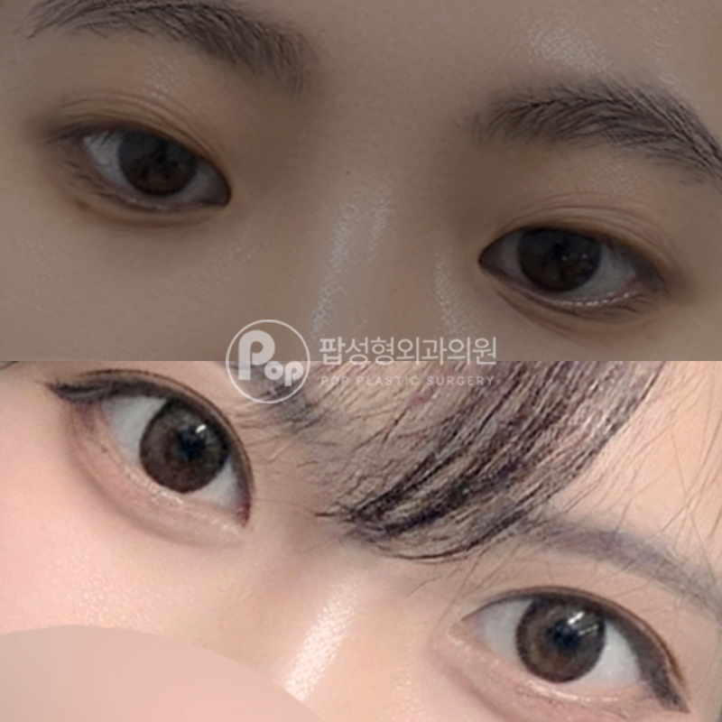팝성형외과 세미아웃 쌍수 눈성형 후기